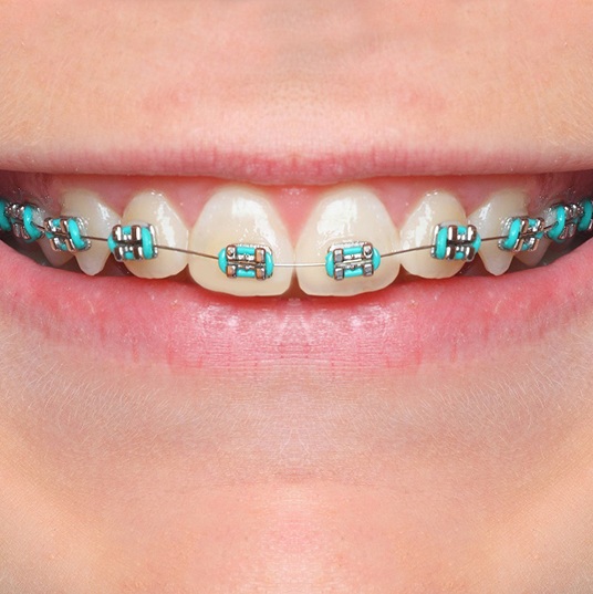 A close-up of a child’s smile with traditional braces