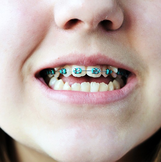 A child wearing braces on their crooked teeth 