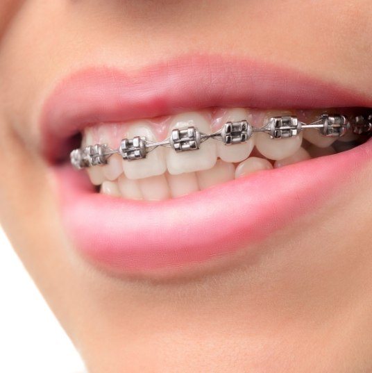 Closeup of smile with braces on top teeth