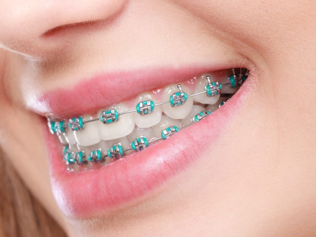person with braces smiling
