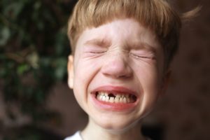 Little boy with brown hair missing a front tooth and crying